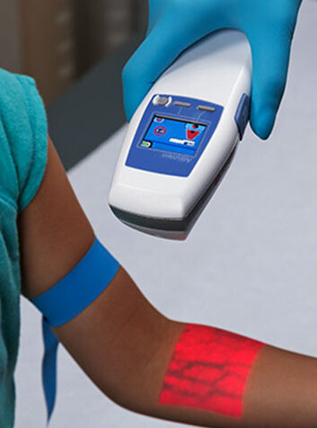 accuvein1-hist4a
